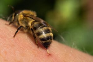 Honigbiene sticht mit ihrem Stachel in die menschliche Haut und gibt Bienengift ab.